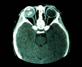 CT-scan
